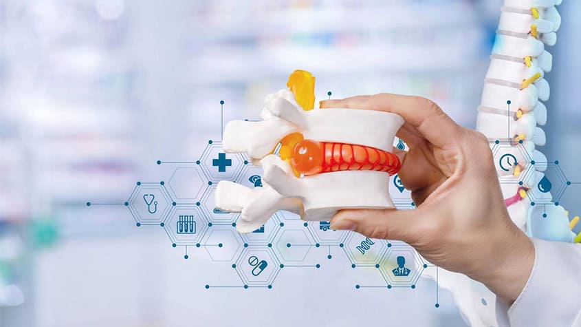 Medical illustration of a spine with herniated disc used in chiropractic treatment